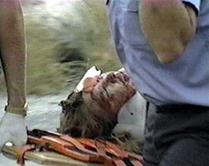 Muzzle Exposion Injury